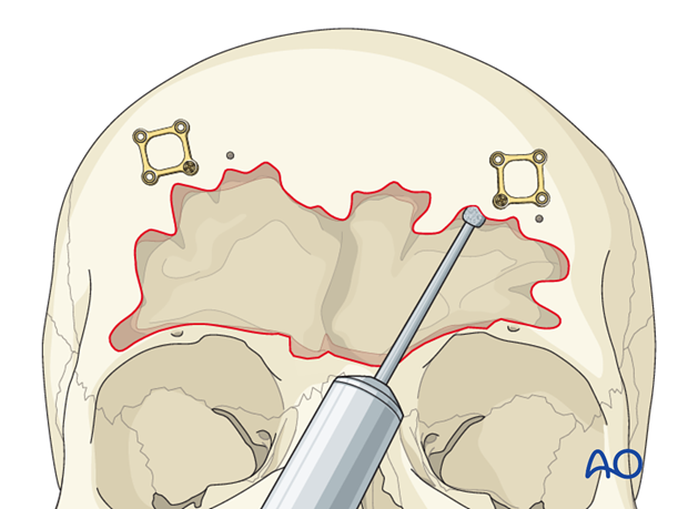 Mucosa removal