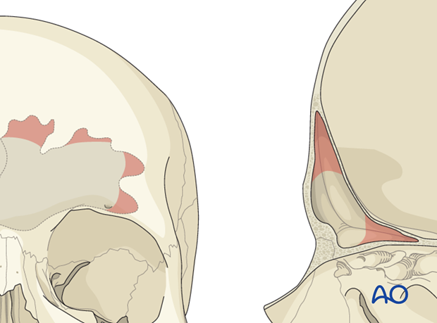 Mucosa removal