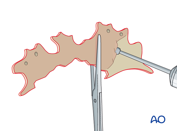 Mucosa removal