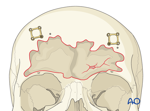 Mucosa removal