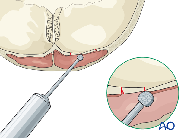 Mucosa removal