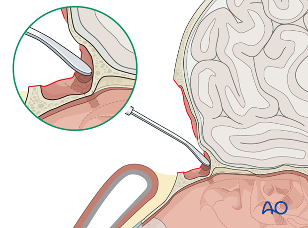 Closure of the outflow tract