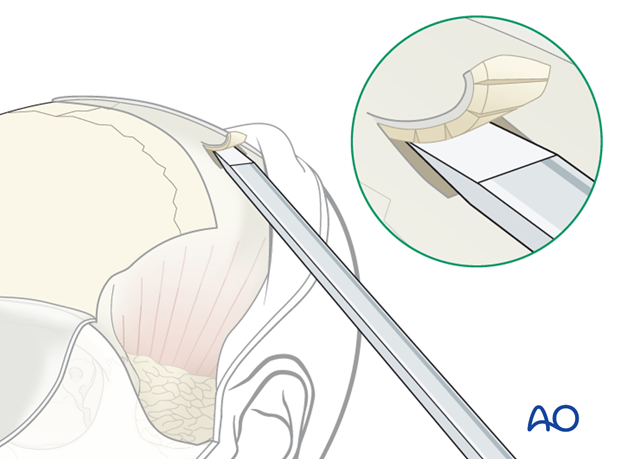 Closure of the outflow tract