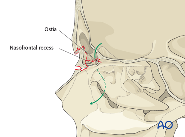 Endoscopic transnasal approach to the frontal sinus