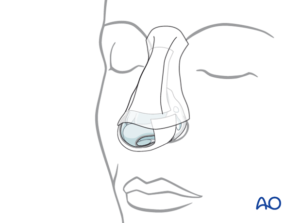 External rhinoplasty approach (open)