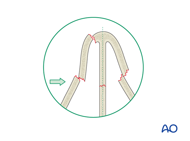 Diagnosis of nasal fractures