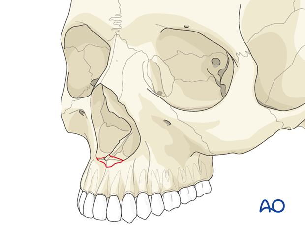 Diagnosis of nasal fractures