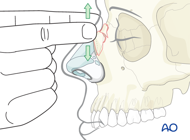 Diagnosis of nasal fractures