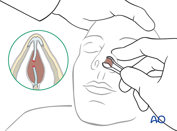 Diagnosis of nasal fractures