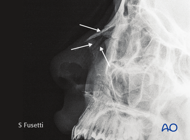 Diagnosis of nasal fractures