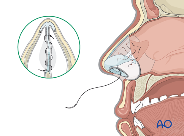 Nasal septum hematoma