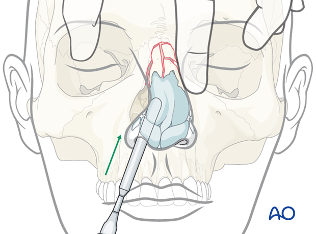 Reduction of nasal bones