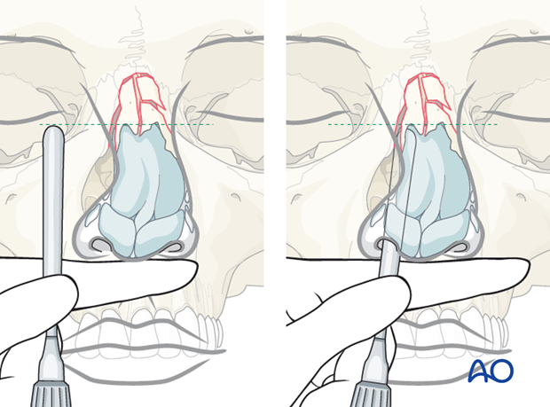 Reduction of nasal bones