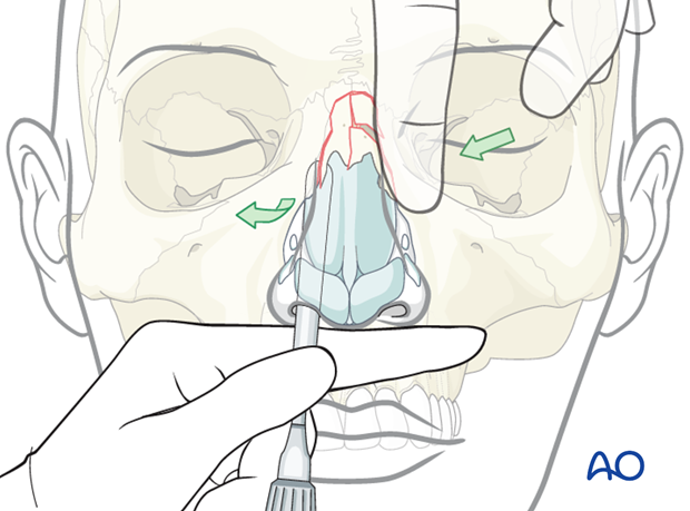 Reduction of nasal bones