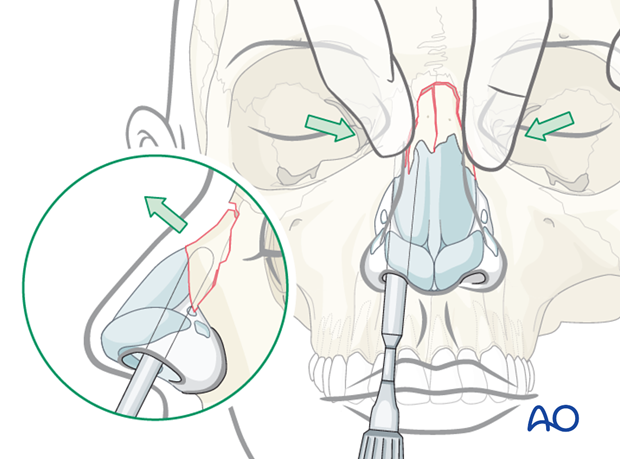 Reduction of nasal bones