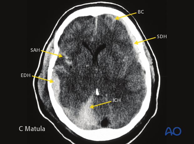 Traumatic brain injuries