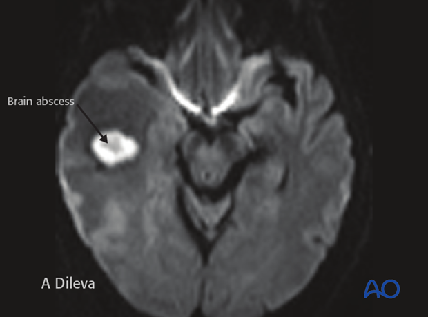 Brain abscess