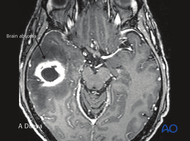 Brain abscess