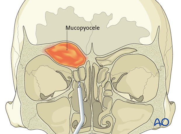 Operative techniques: Transnasal endoscopic approach