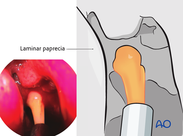 Operative techniques: Transnasal endoscopic approach