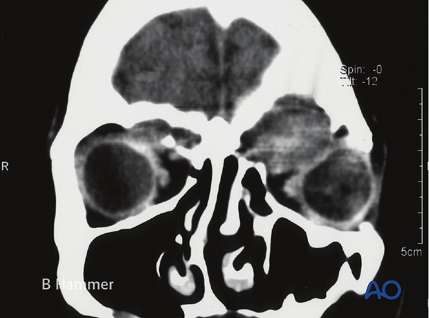 Case example: Mucocele with globe displacement