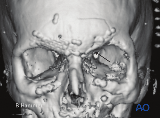 Case example: Mucocele with globe displacement