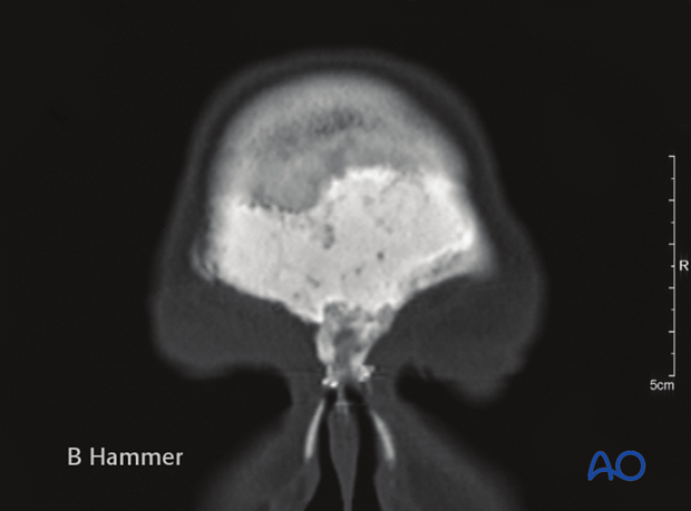 Case example: Infection of a hydroxyapatite graft