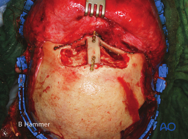 Case example: Infection of a hydroxyapatite graft