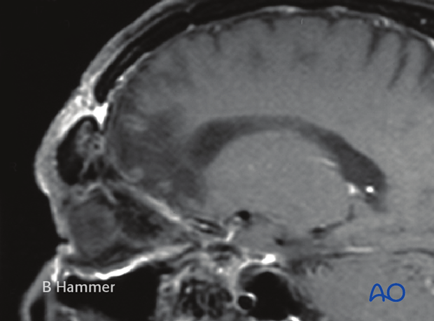 Case example: Infection of a PMMA graft causing recurrent fistulae