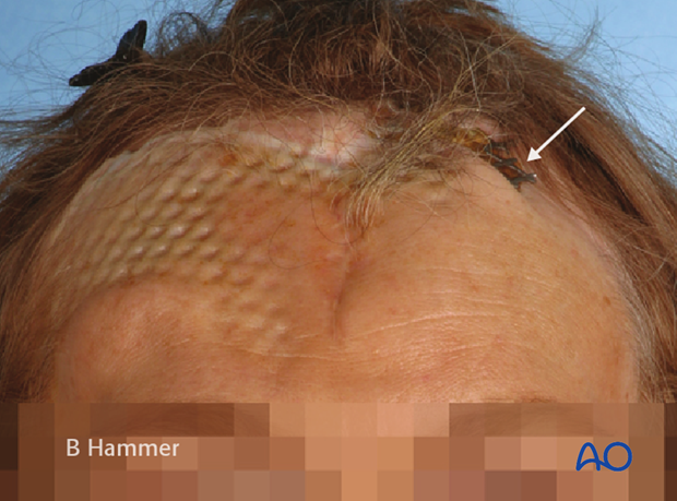 Case example: Exposure of a titanium mesh through the skin