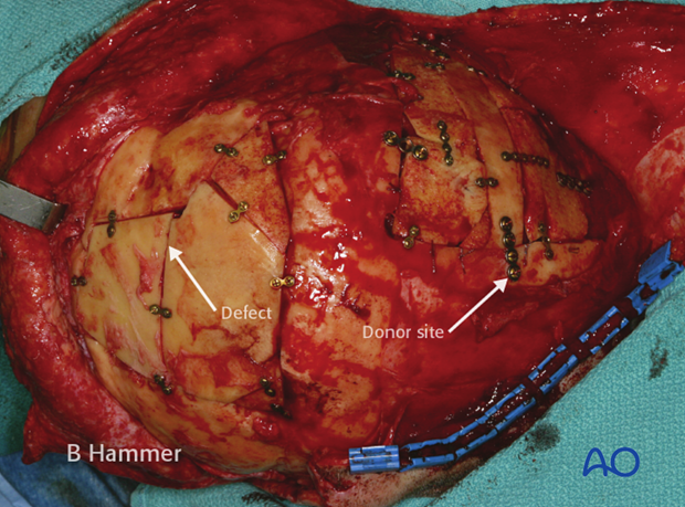 Case example: Exposure of a titanium mesh through the skin