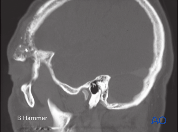 Case example: Osteomyelitis of the supraorbital rim with fistulization