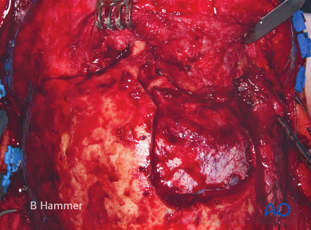 Case example: Osteomyelitis of the supraorbital rim with fistulization