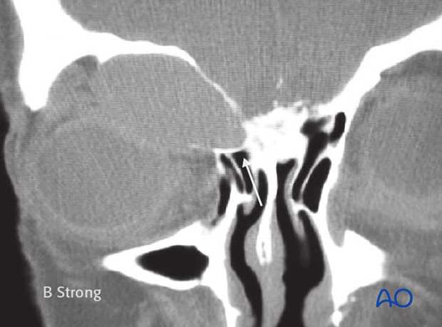 Operative techniques: Transnasal endoscopic approach