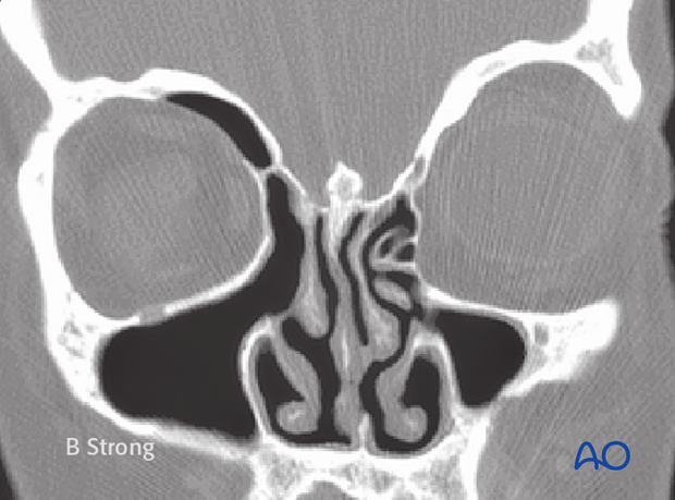 Operative techniques: Transnasal endoscopic approach