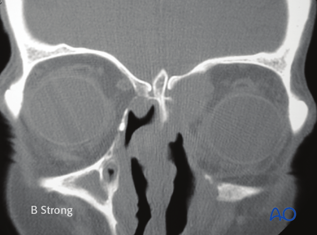 Operative techniques: Transnasal endoscopic approach