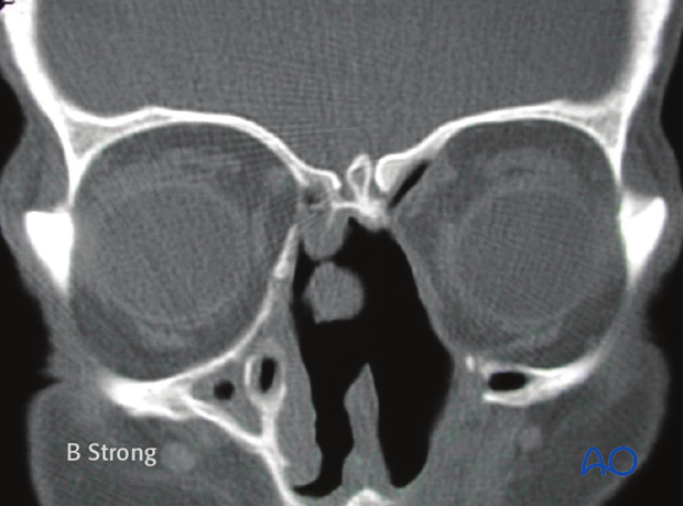 Operative techniques: Transnasal endoscopic approach