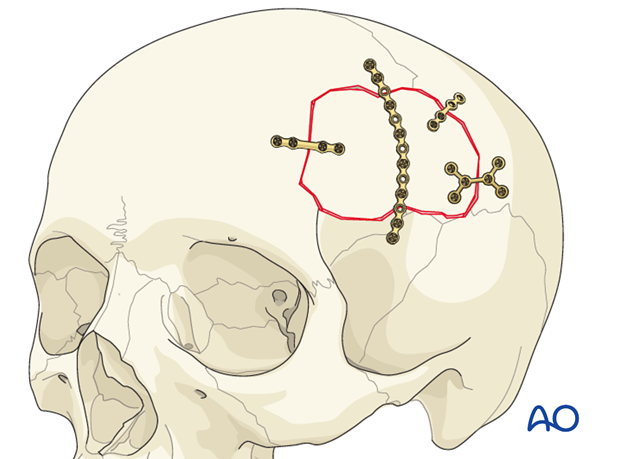 Load bearing repair when bone is used in cranioplasty