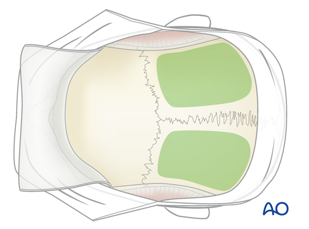 Harvesting of calvarial bone graft