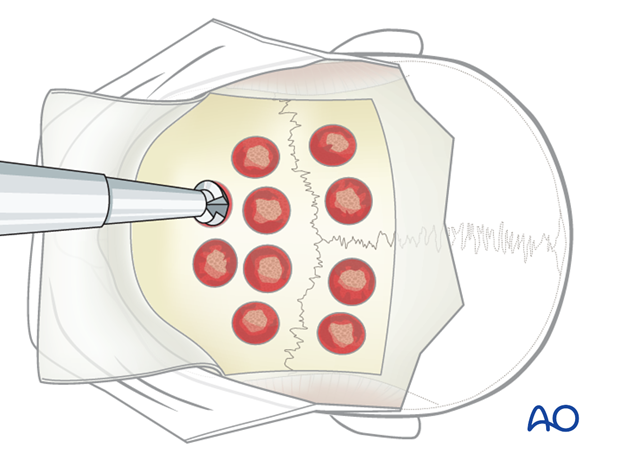 Harvesting of calvarial bone graft