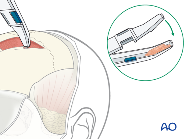 Harvesting of calvarial bone graft