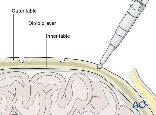 Harvesting of calvarial bone graft