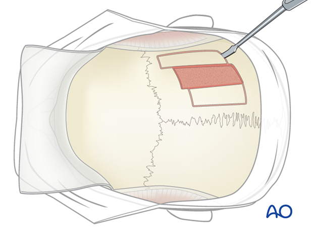 Harvesting of calvarial bone graft