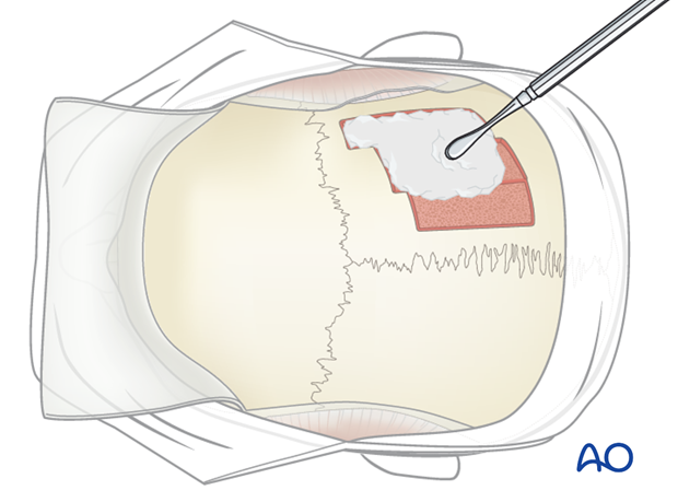 Harvesting of calvarial bone graft