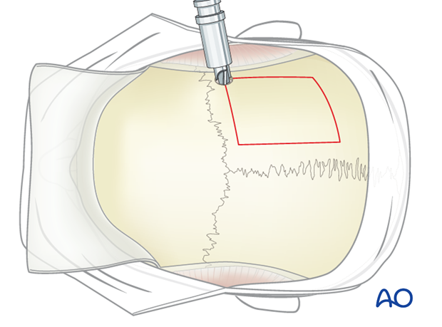 Harvesting of calvarial bone graft