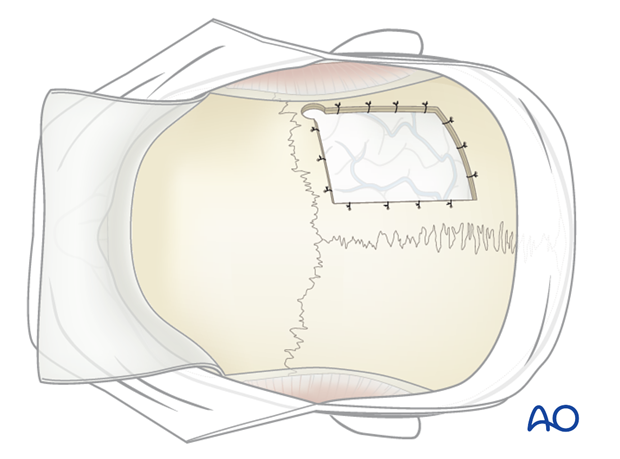 Harvesting of calvarial bone graft