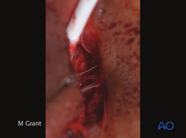 Repair of periorbital soft-tissue injuries and lacrimal system in NOE injuries