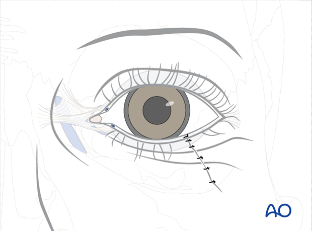 Repair of periorbital soft-tissue injuries and lacrimal system in NOE injuries