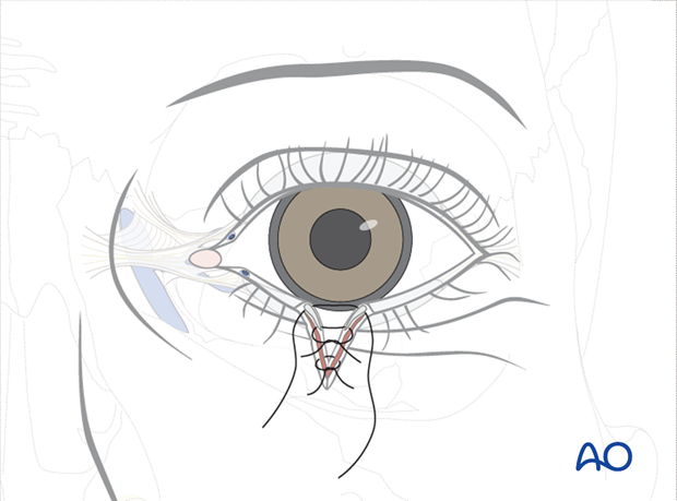 Repair of periorbital soft-tissue injuries and lacrimal system in NOE injuries