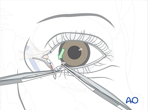 Repair of periorbital soft-tissue injuries and lacrimal system in NOE injuries